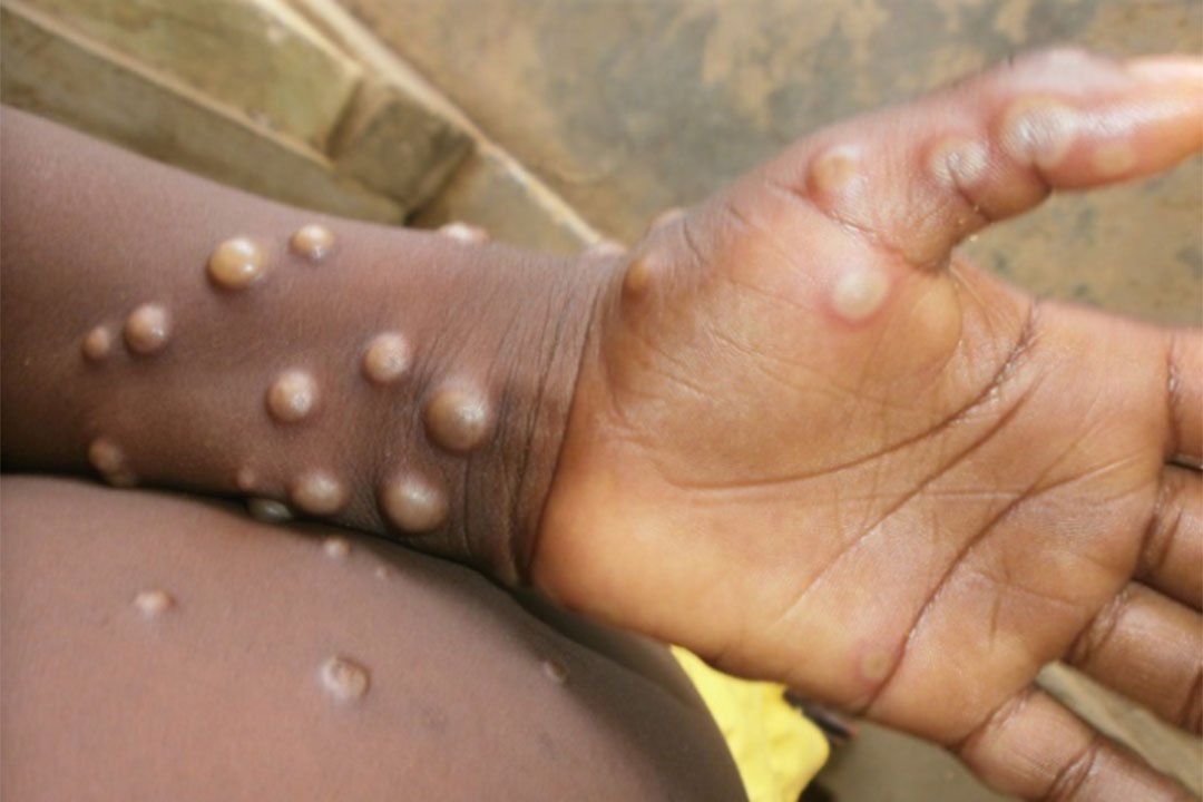 Zimbabwe on Mpox high alert scales up disease surveillance and reinforced screening at all points of