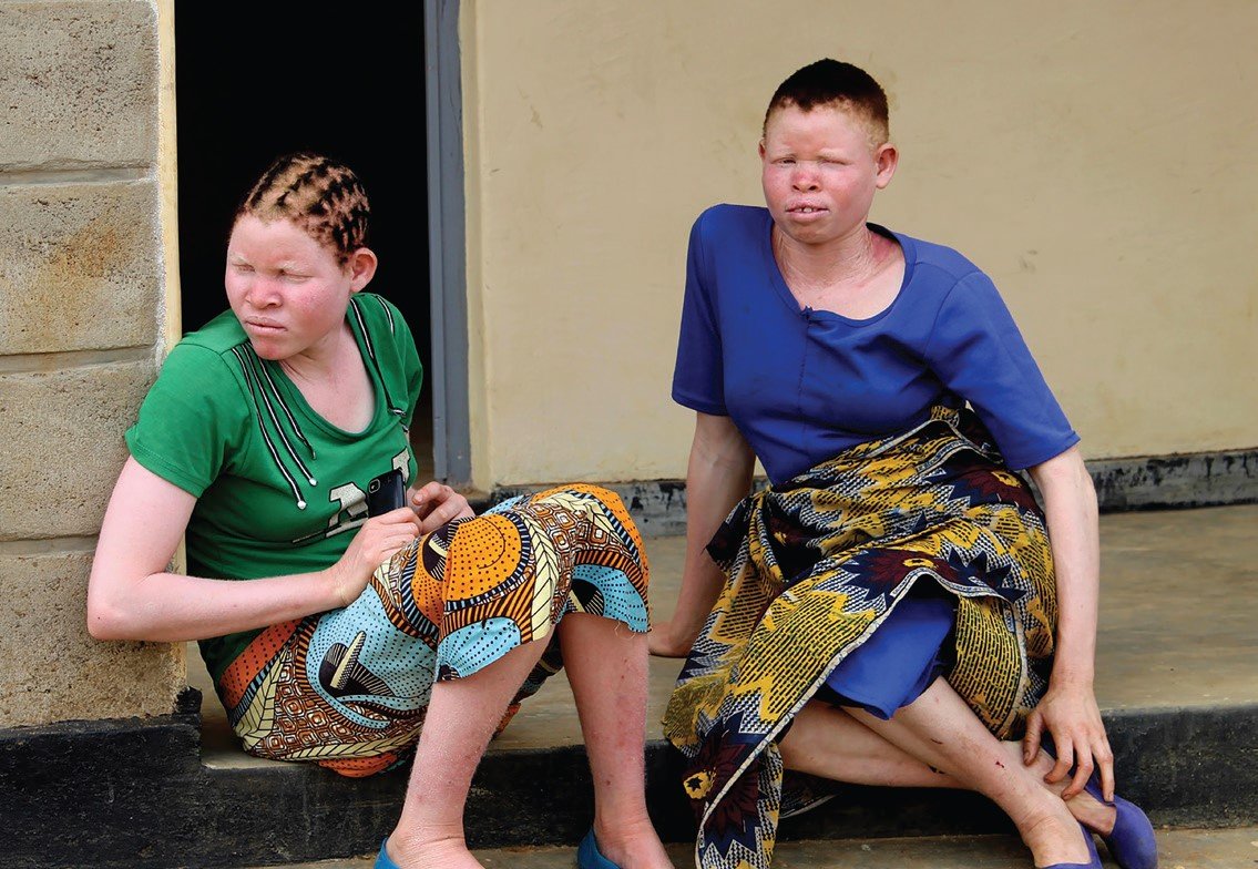 APM orders protection of people with albinism
