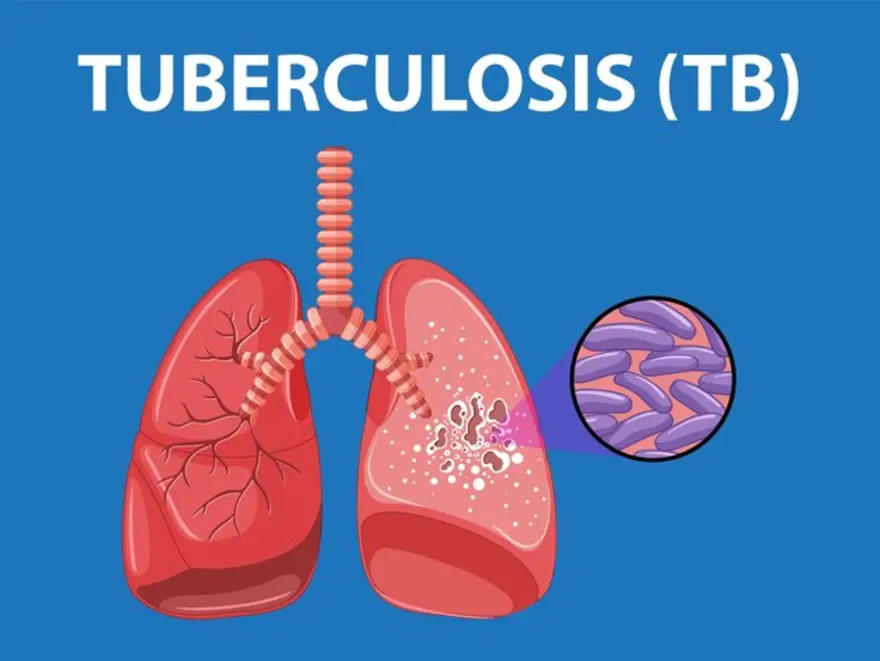Communities Urged to Dispel TB Myths as Health Experts Warn Misconceptions Are Fueling Treatment Default