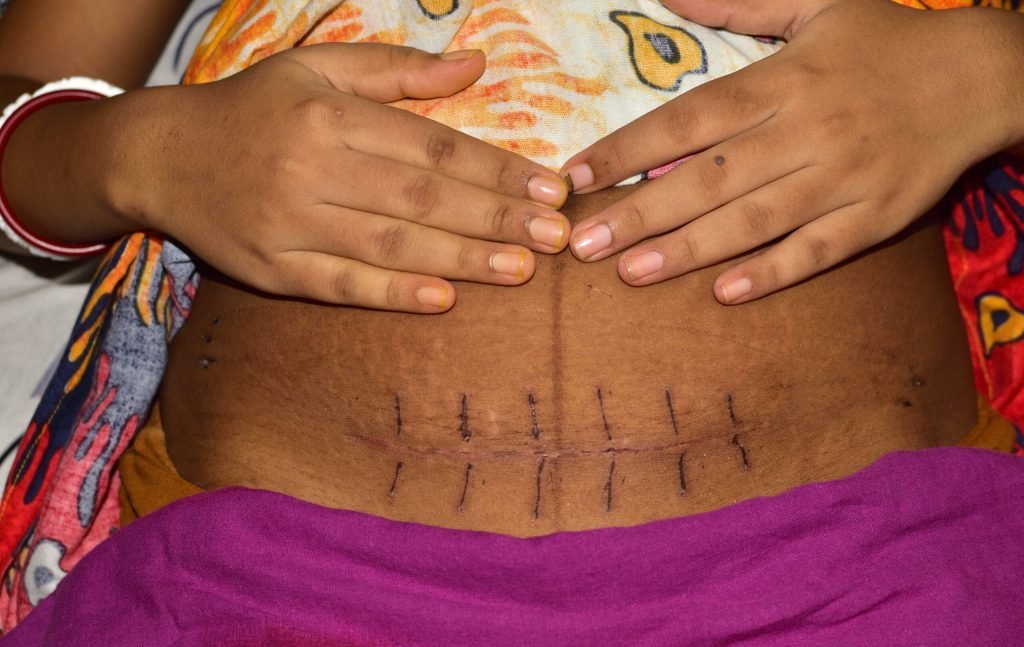 Promoting safe motherhood through safe C-sections