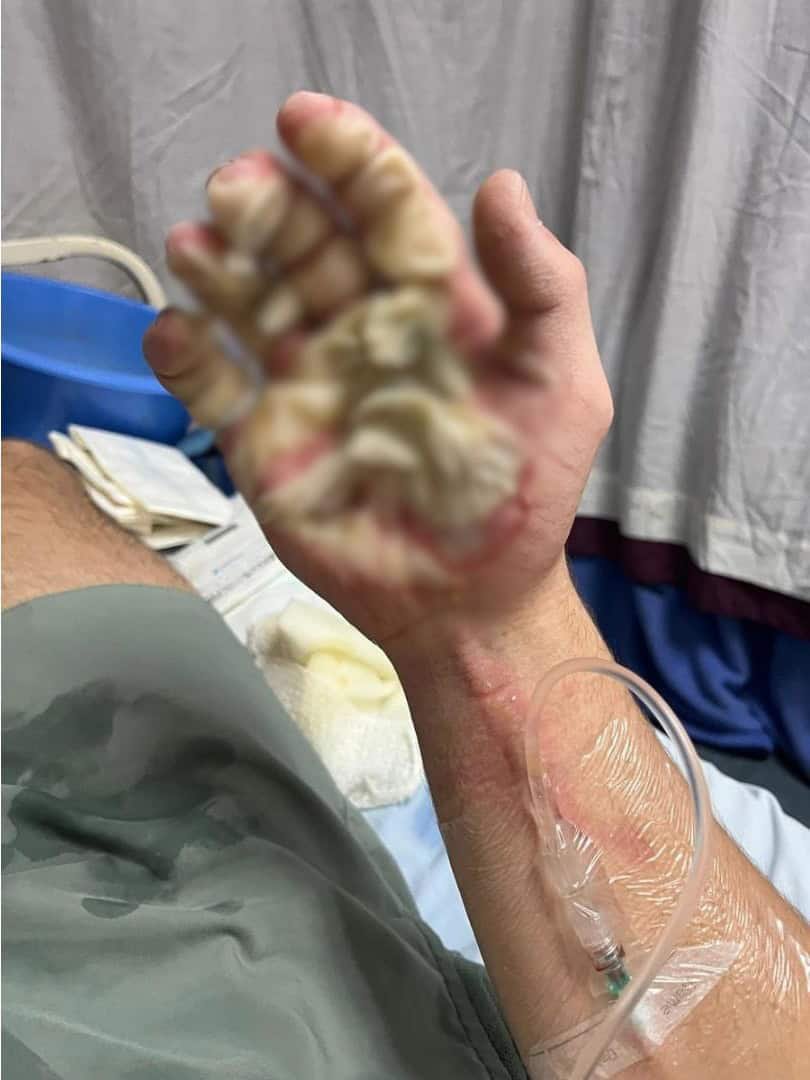 Pretoria man severely burnt in freak gym accident